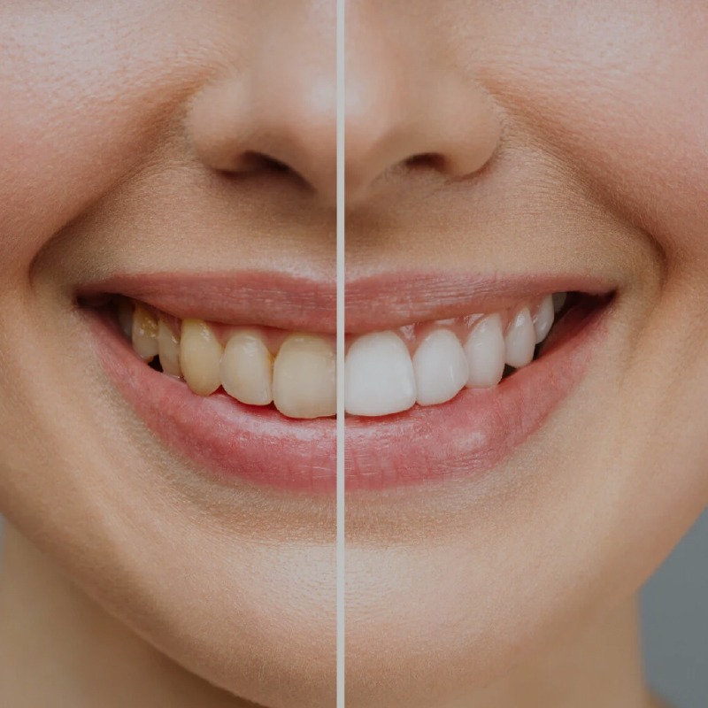 BLANQUEAMIENTO DENTAL